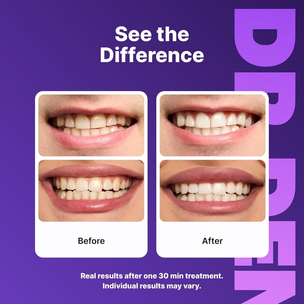 Brilliant Smile Whitening Strips